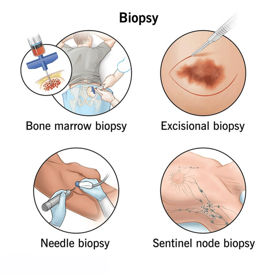 BIOPSY