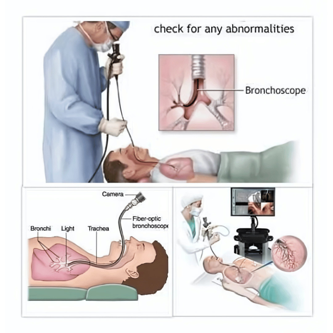 BRONCHOSCOPY