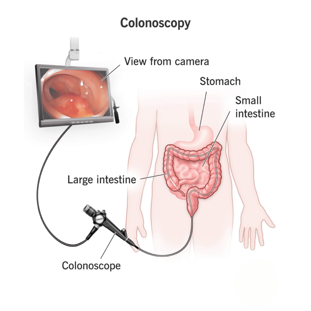 COLONOSCOPY